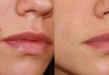 Когда необходимо удаление родинок?