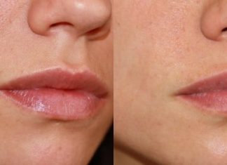 Когда необходимо удаление родинок?