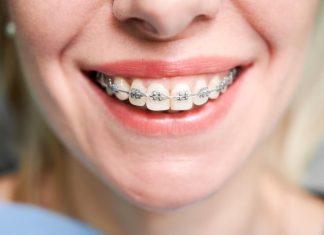 Брекеты: современный путь к красивой и здоровой улыбке